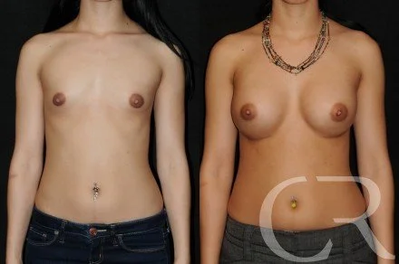 breast-augmentation-6.jpg