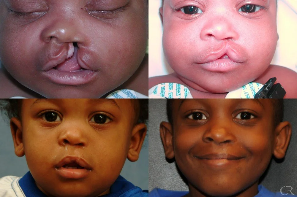 cleft-lip-14.jpg