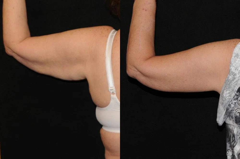 brachioplasty-7.jpg
