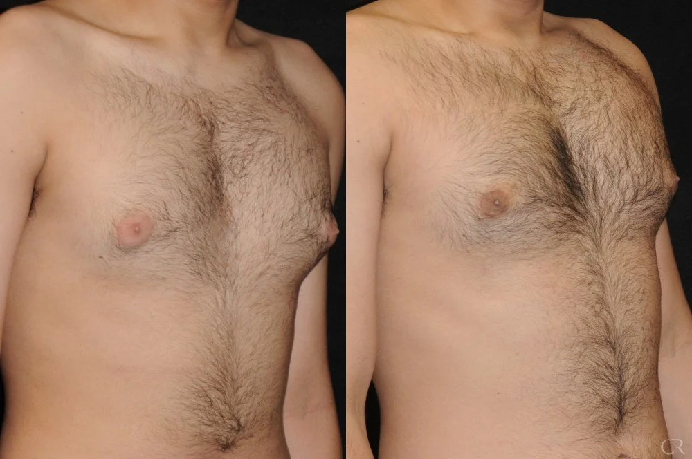 chest-gynecomastia-5.jpg