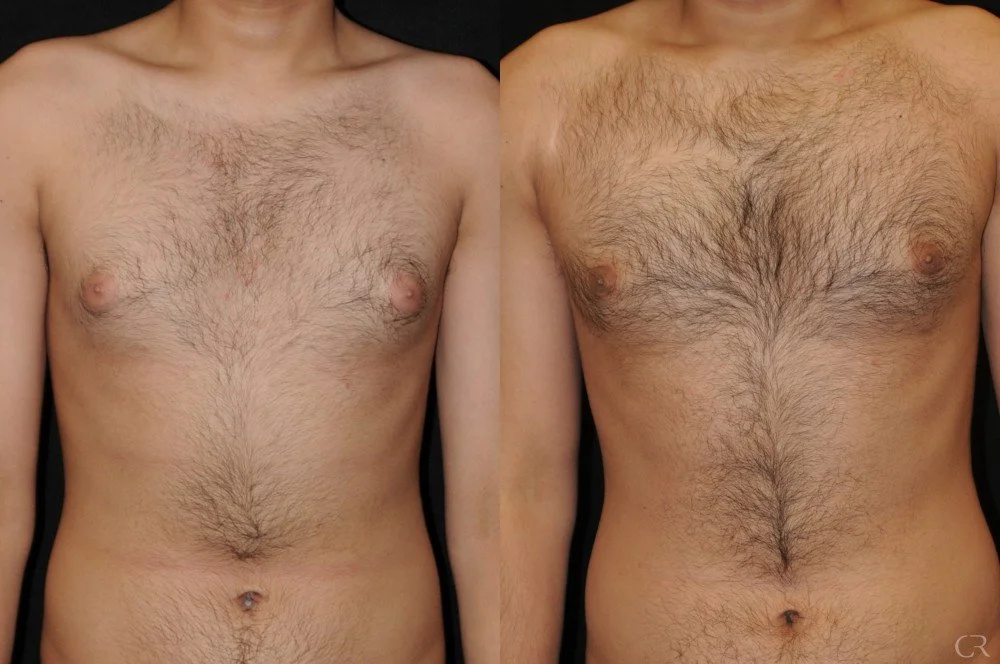 chest-gynecomastia-3.jpg