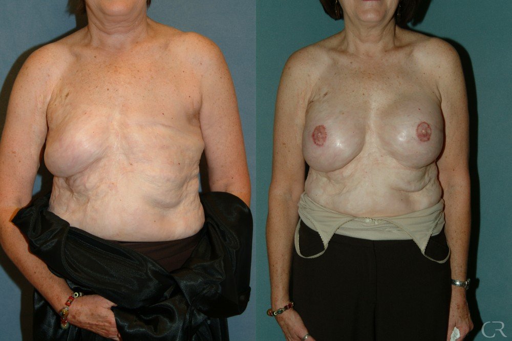 breast-reconstruction-8.jpg