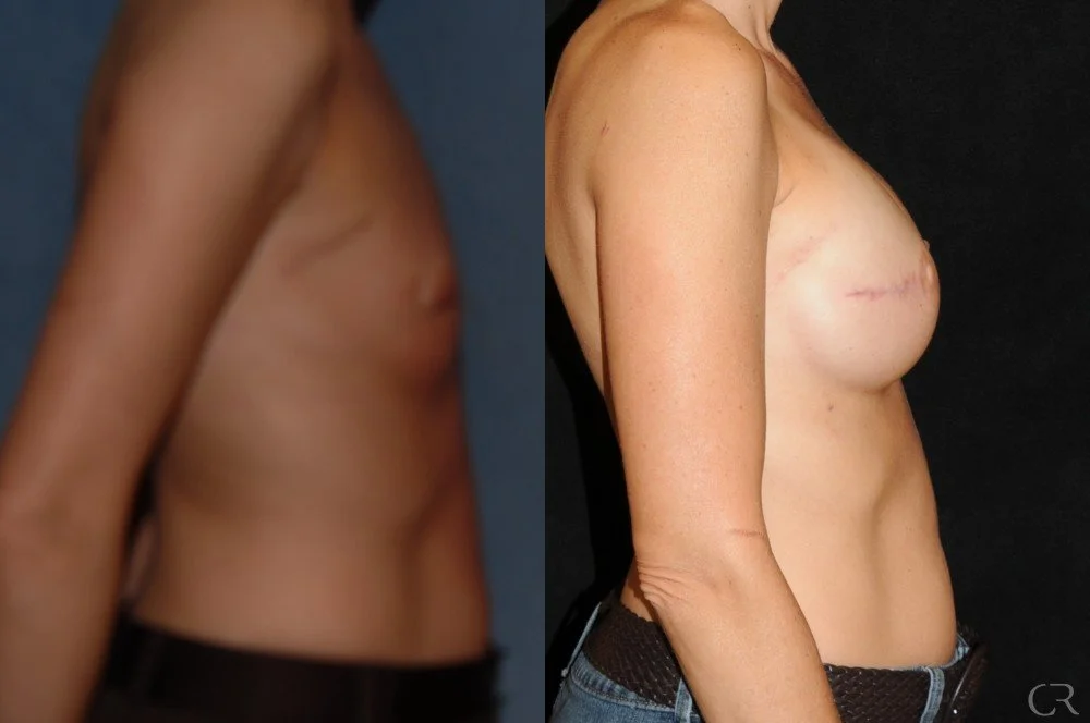 breast-reconstruction-3.jpg