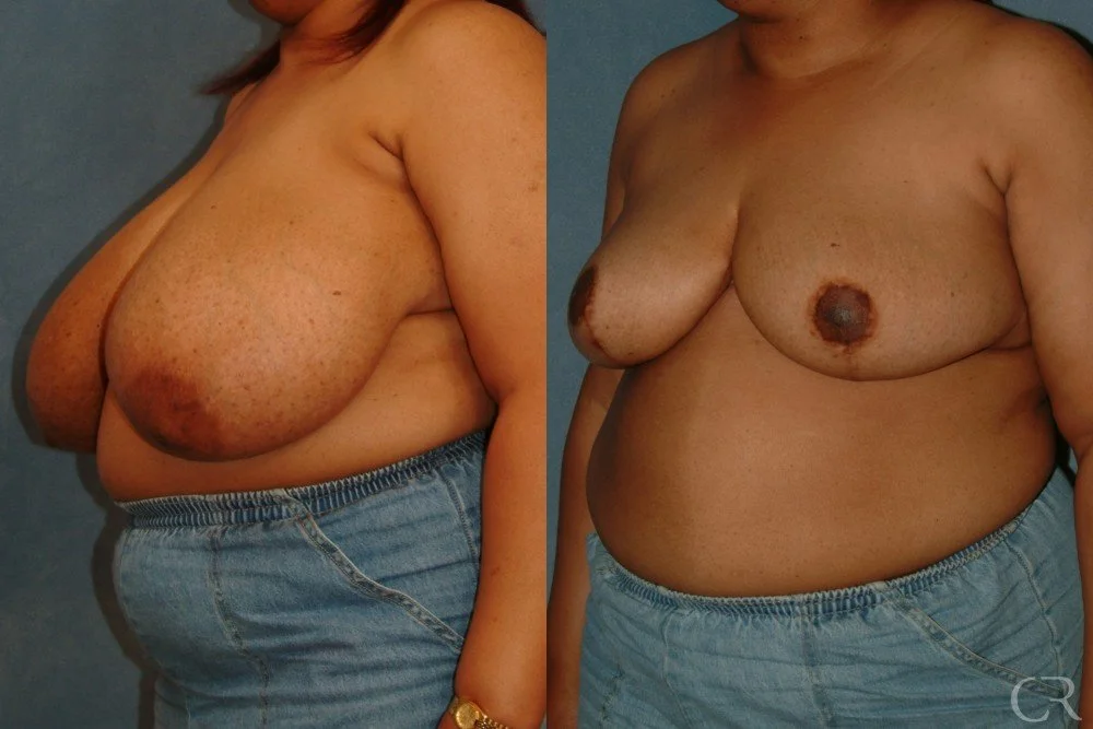 breast-reduction-13.jpg