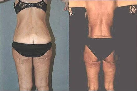 body lift patient 2 (9).jpg