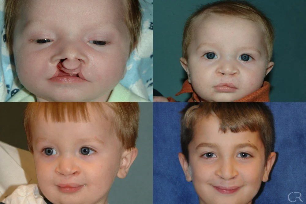 cleft-lip-20.jpg