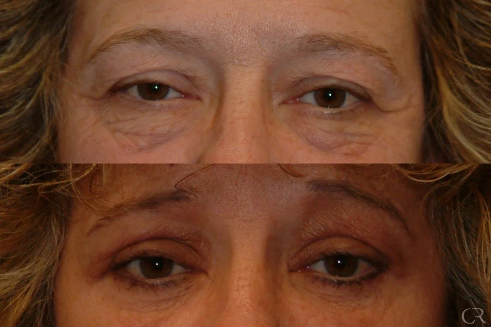 blepharoplasty-17.jpg