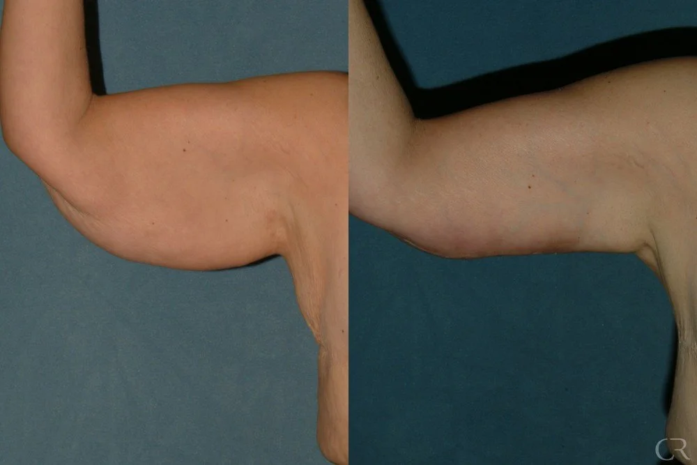 brachioplasty-14.jpg