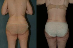 body lift patient 4 (1).jpg