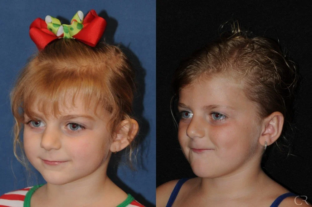 pediatric-otoplasty-19.jpg