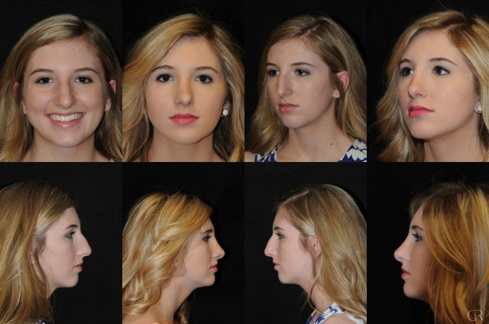 rhinoplasty-1.jpg