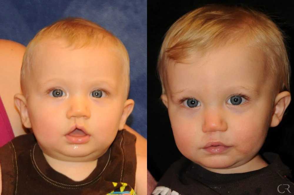 cleft-lip-5.jpg