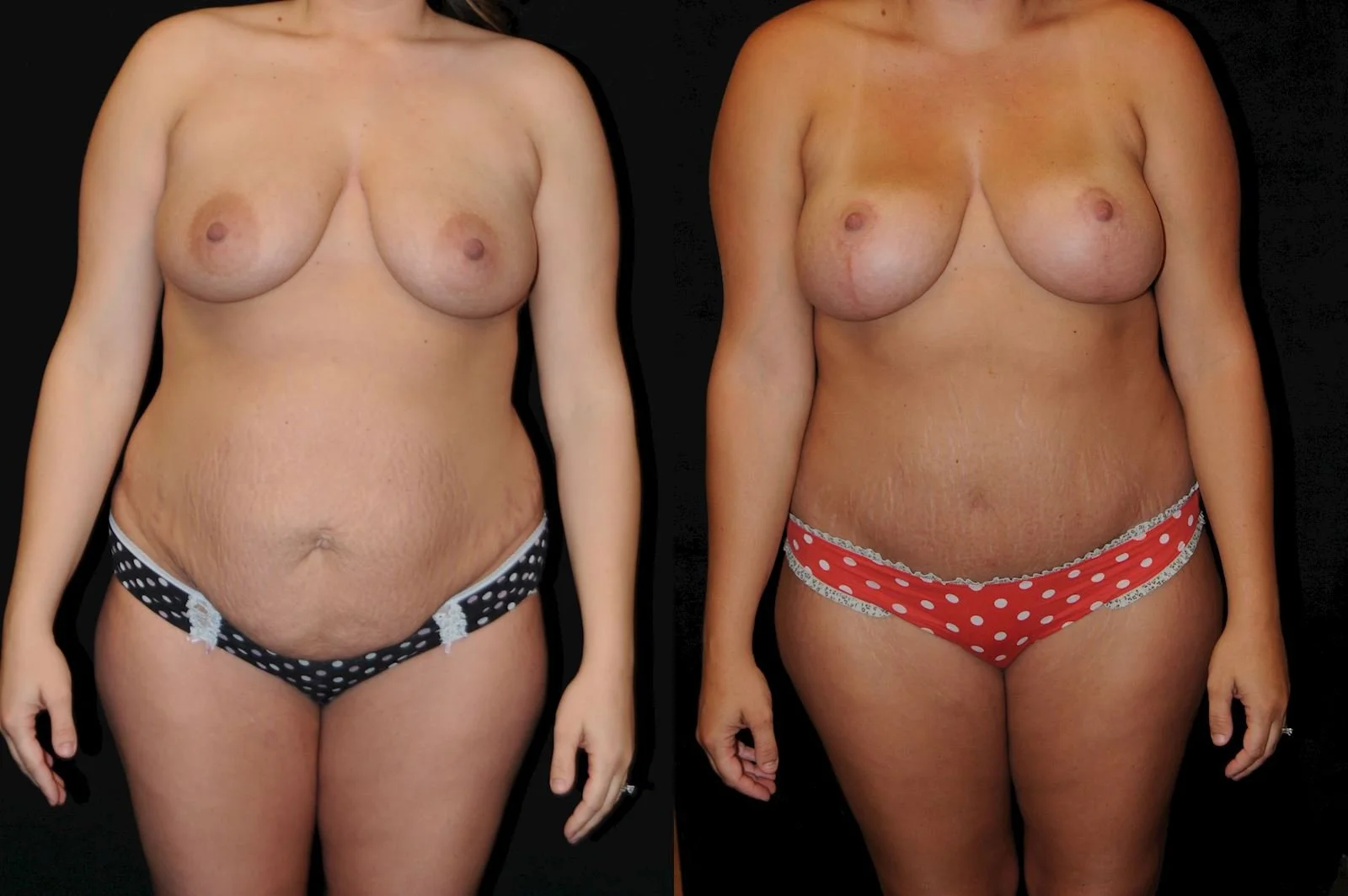 mommy makeover abdominoplasty mastopex (2).jpg