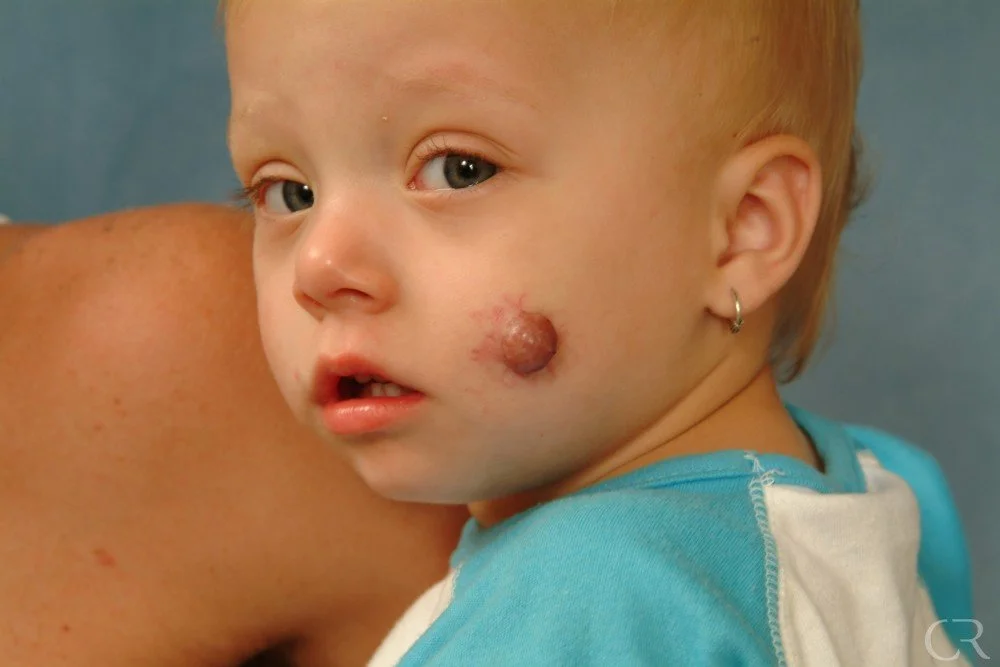 hemangioma-34.jpg