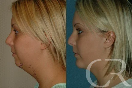 chin-augmentation-2.jpg
