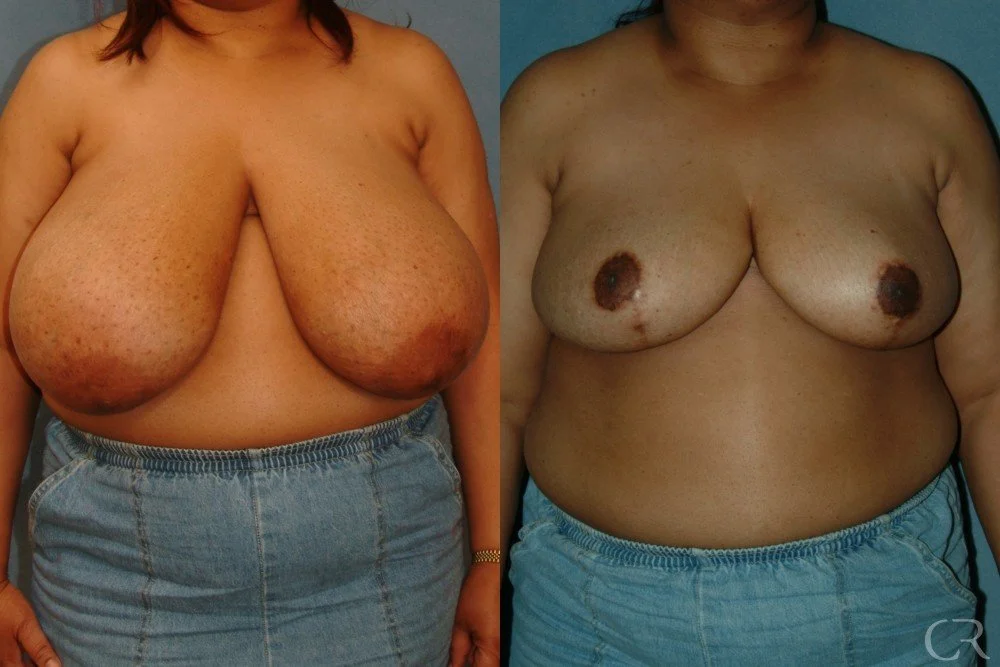breast-reduction-12.jpg