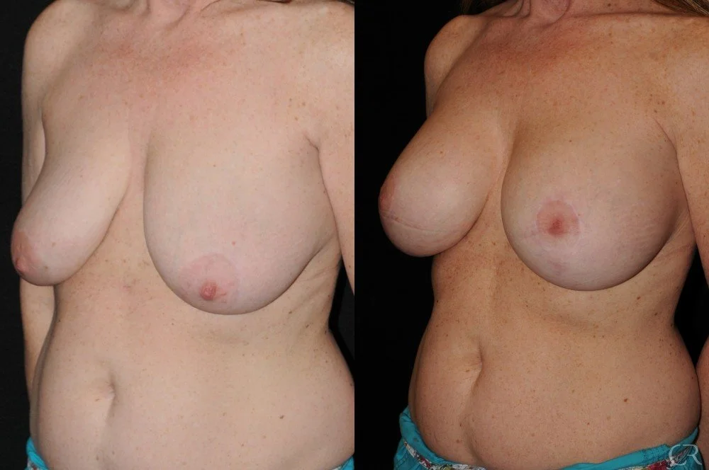 breast-lift-12.jpg
