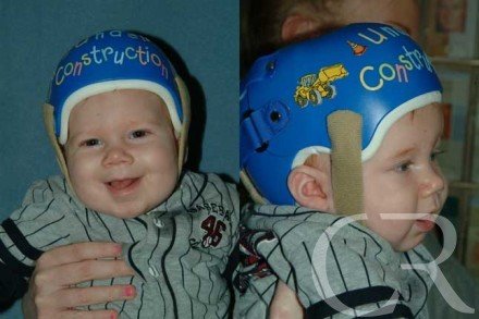plagiocephaly-7.jpg