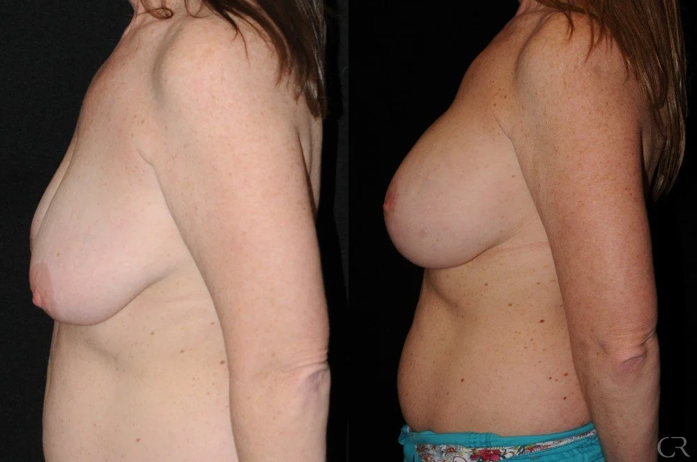 breast-lift-13.jpg