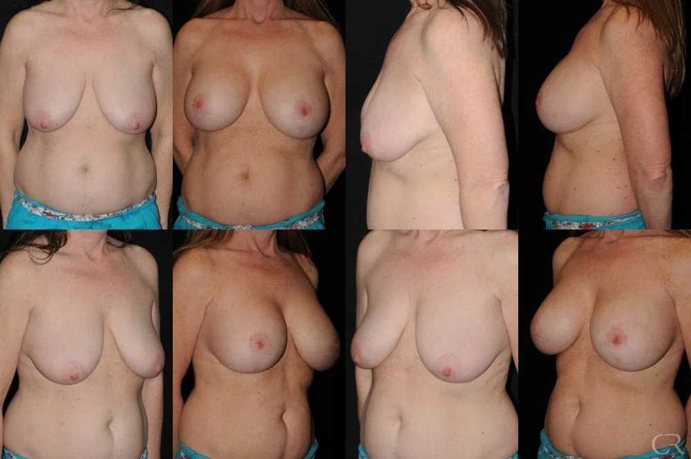 breast-lift-9.jpg