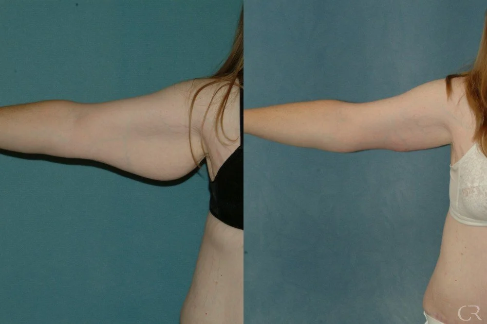 brachioplasty-12.jpg