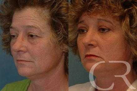 blepharoplasty-32.jpg
