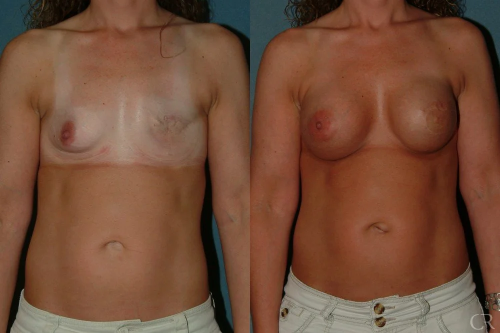 breast-reconstruction-6.jpg