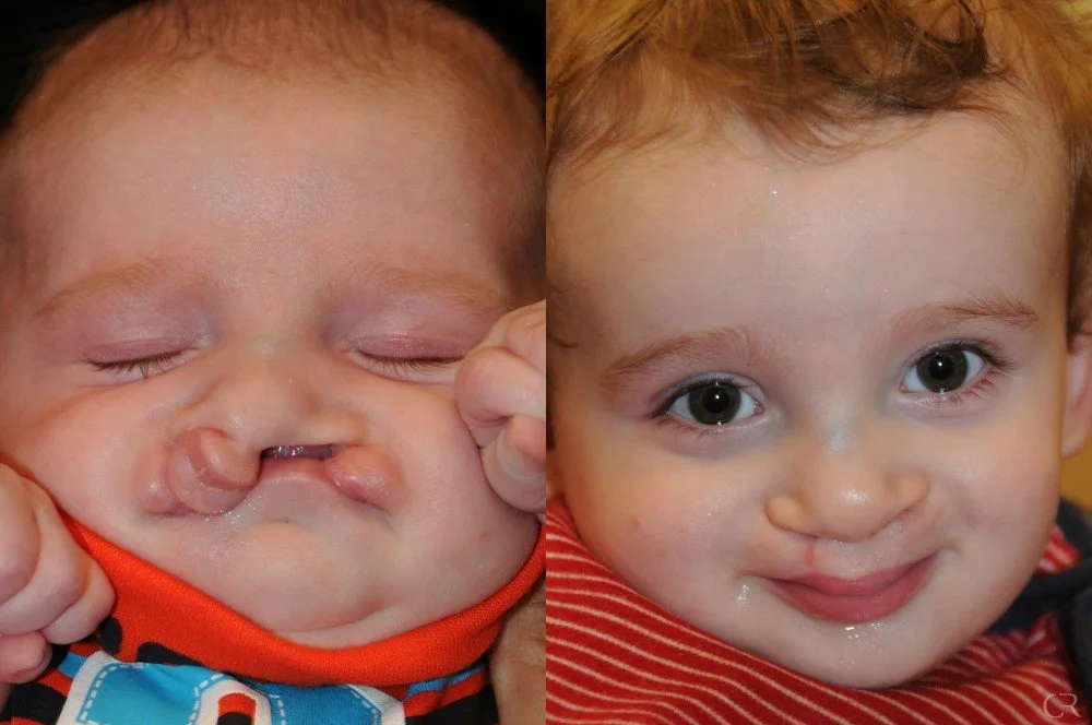 cleft-lip-15.jpg