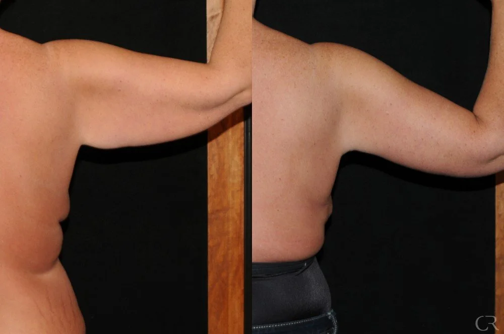 brachioplasty-3.jpg