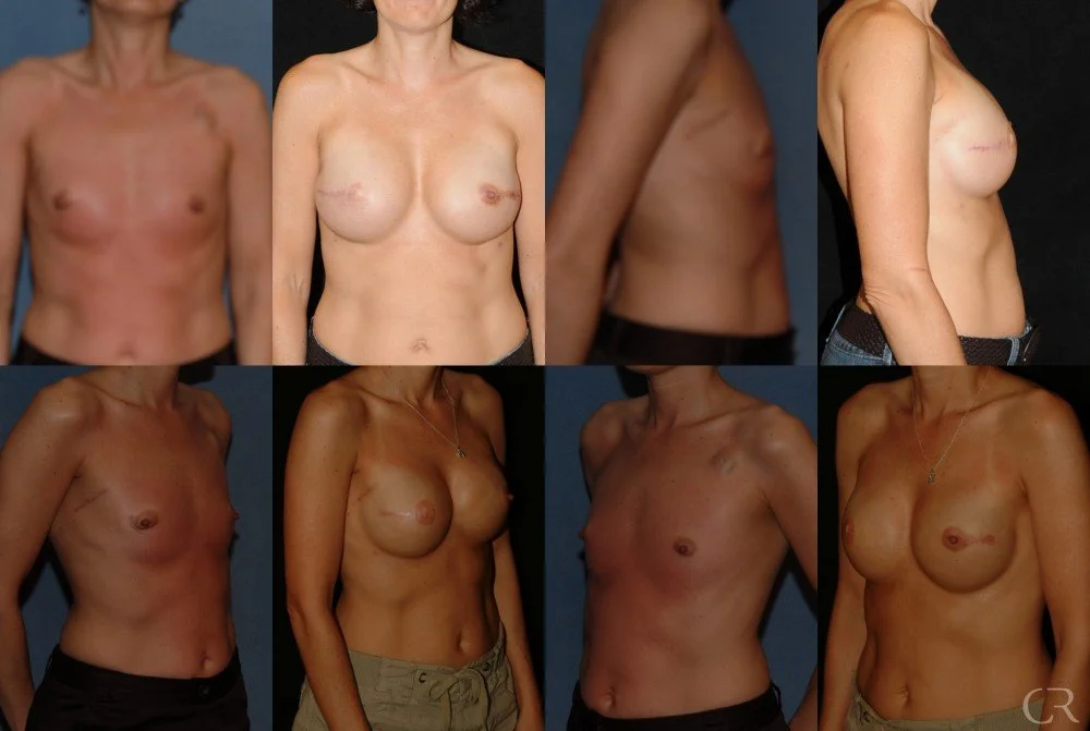 breast-reconstruction-1.jpg