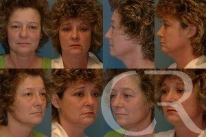blepharoplasty-21.jpg