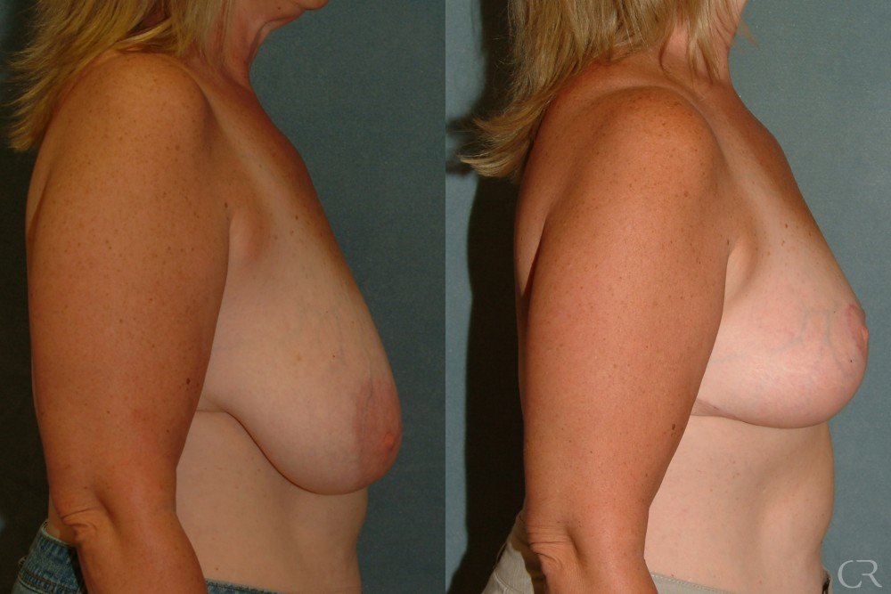 mastopexy-6.jpg