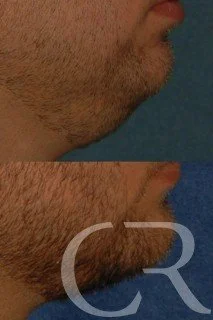 chin-augmentation-4.jpg