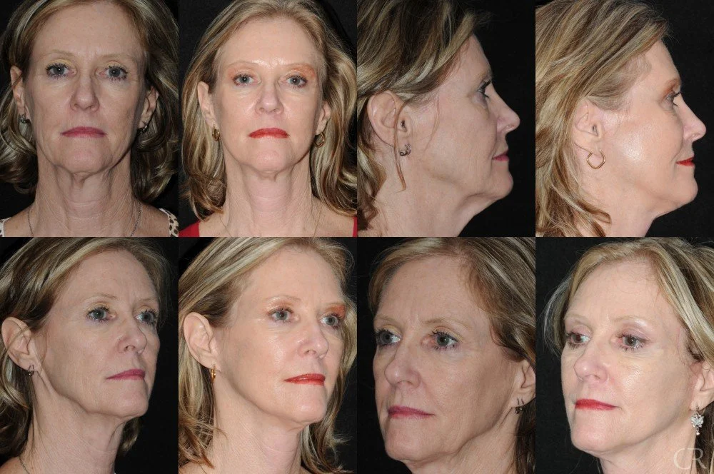 facelift-necklift-5.jpg
