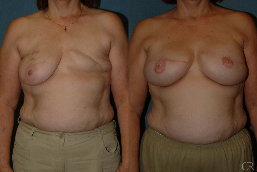breast-reconstruction-7.jpg