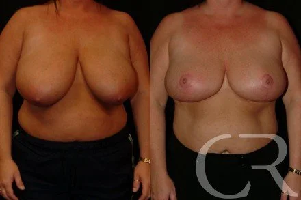 breast-reduction-8.jpg