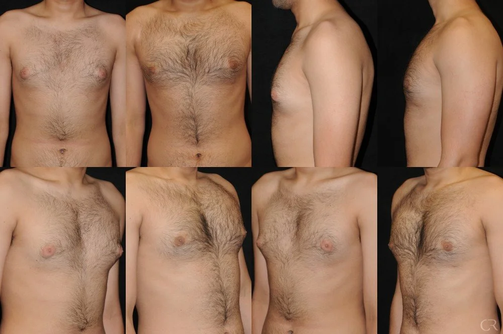 chest-gynecomastia-2.jpg