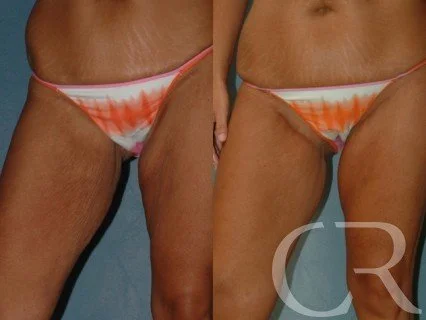 thigh-lift-1.jpg