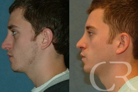 rhinoplasty-6.jpg
