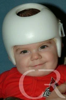 plagiocephaly-5.jpg