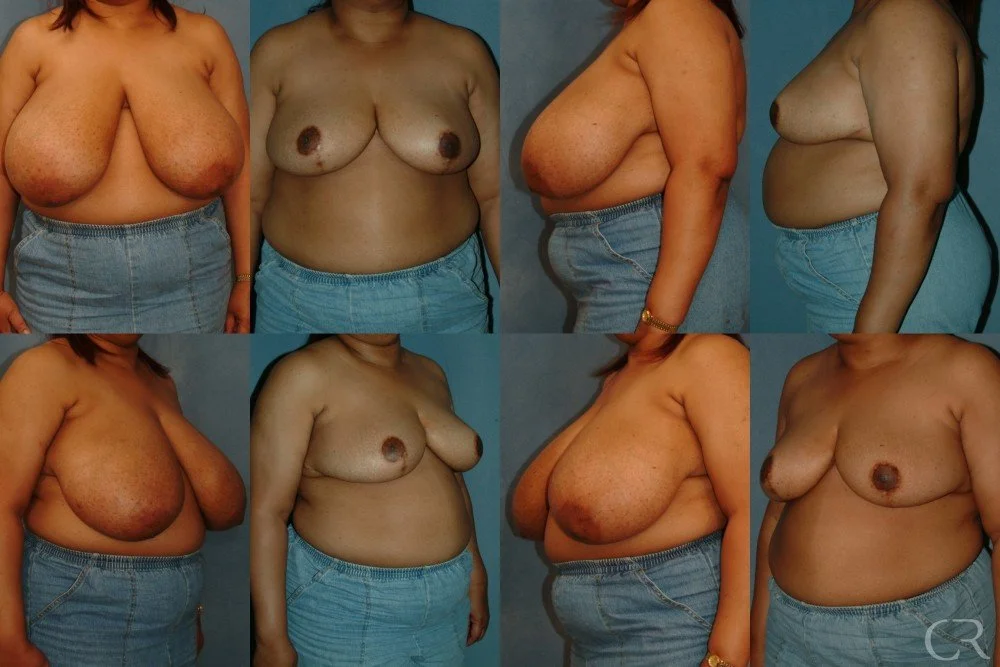 breast-reduction-11.jpg