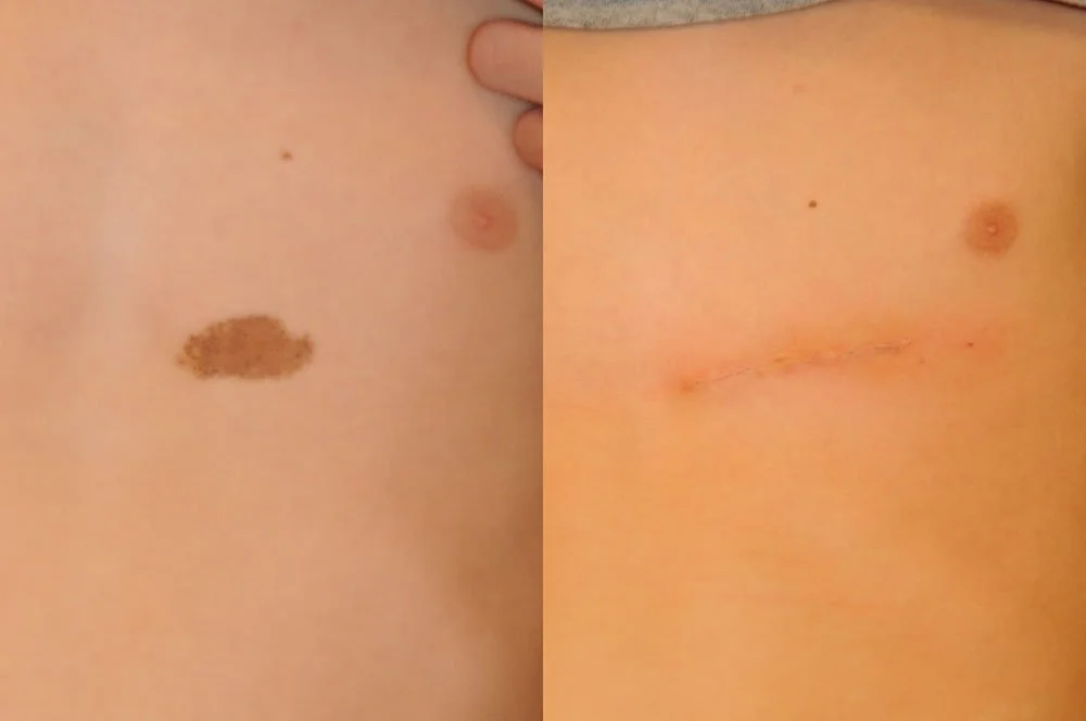 congenital-nevus-4.jpg