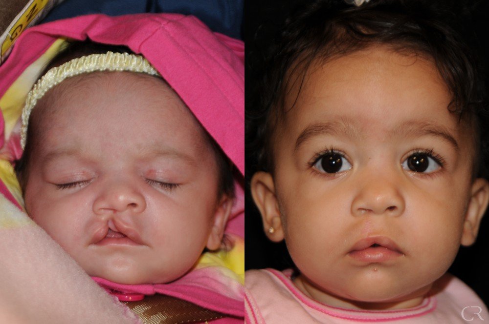 cleft-lip-22.jpg