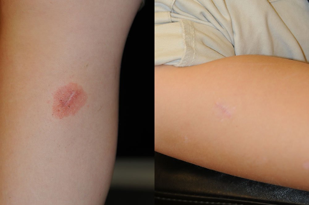 congenital nevus (9).jpg