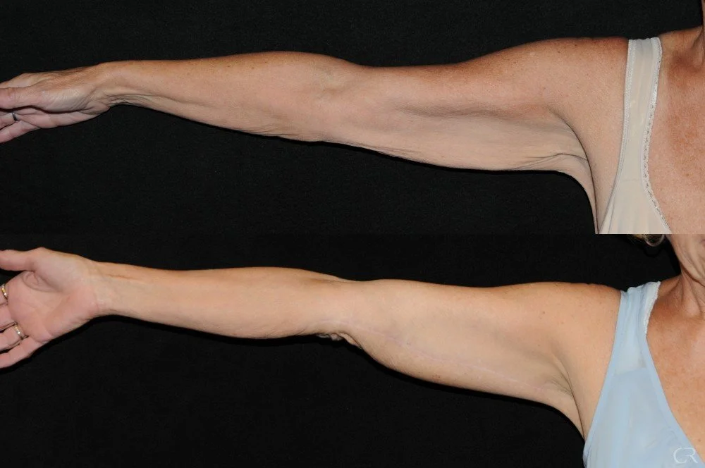 brachioplasty-5.jpg