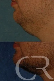 chin-augmentation-1.jpg