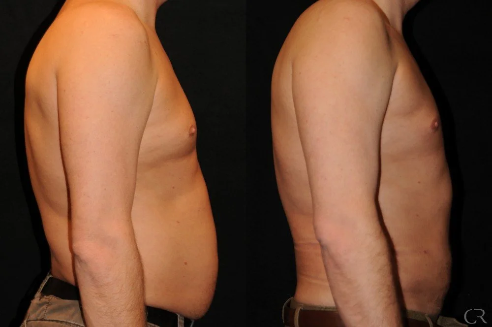 liposuction-4.jpg