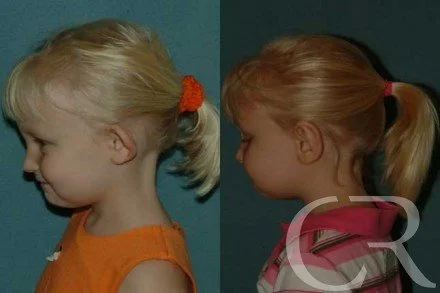 pediatric-otoplasty-2.jpg
