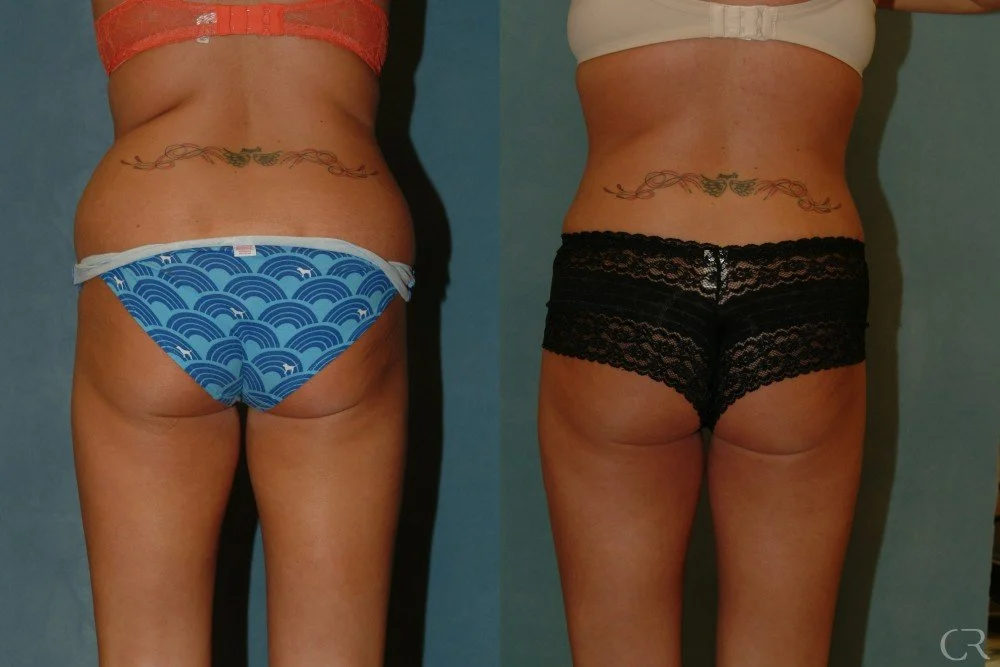 liposcution-7.jpg
