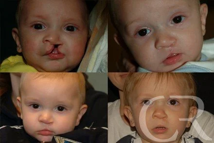 cleft-lip-12.jpg